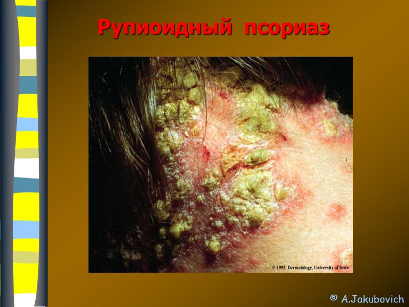 Рупиоидный  псориаз   © A.Jakubovich